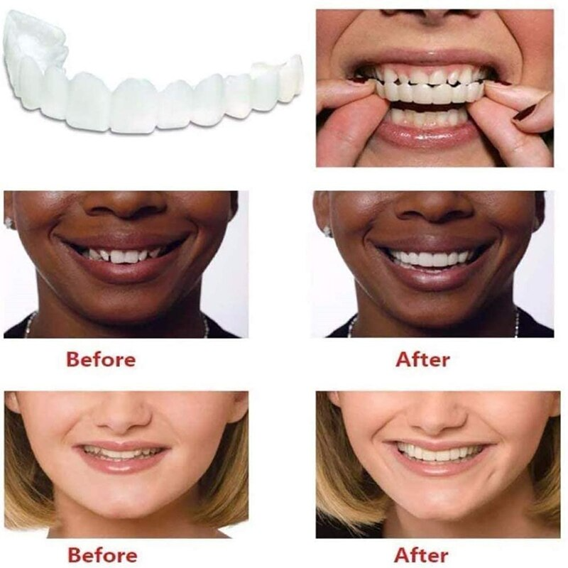 HappySmile™ - Silicone Tanden Voor Een Stralende Glimlach (Backup Pack)