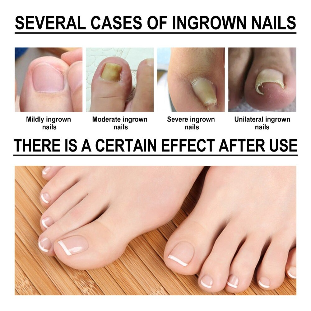 HappyNails™ - Anti Paronychia Olie