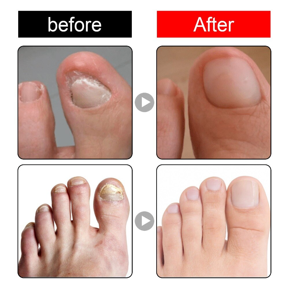 HappyNails™ - Anti Paronychia Olie