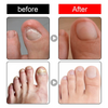 HappyNails™ - Anti Paronychia Olie