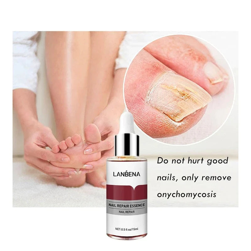 Ultrax™ - Herstel Van Schimmelnagel - 15ml