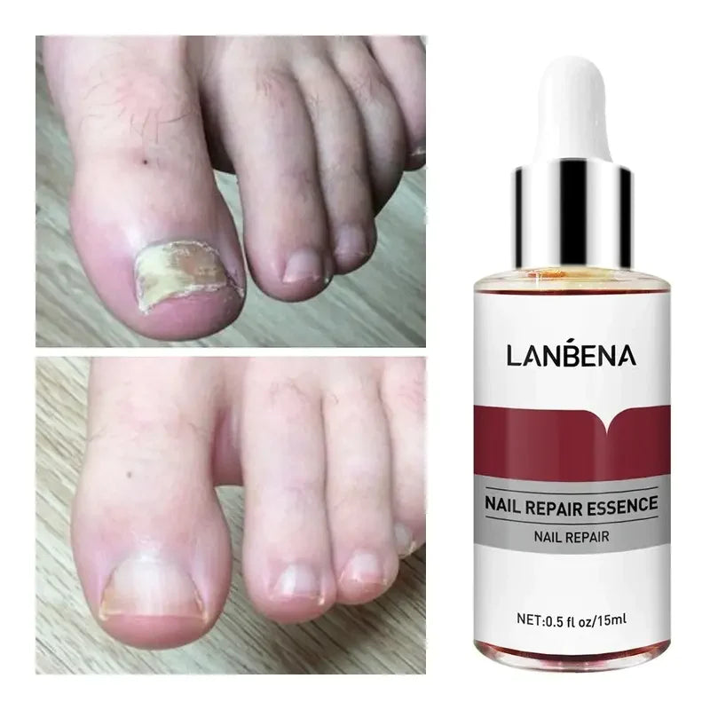 Ultrax™ - Herstel Van Schimmelnagel - 15ml